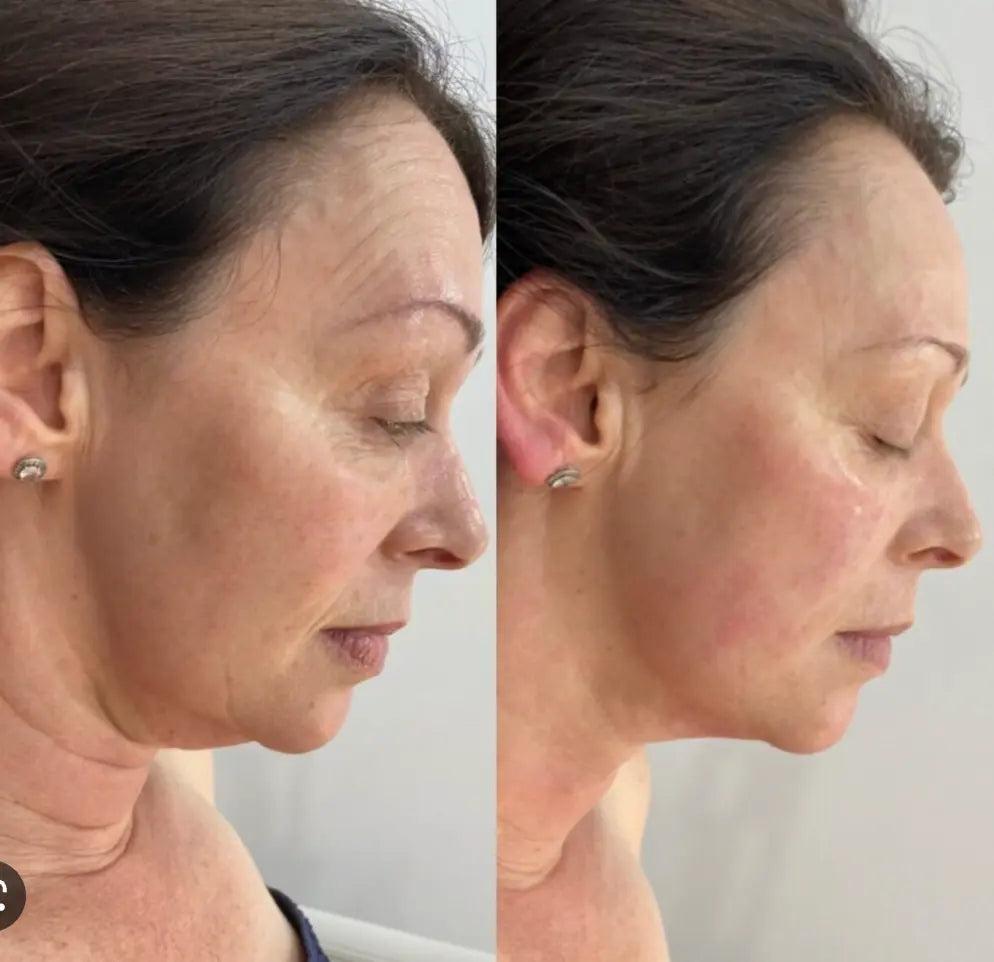 HIFU, EMS and Microcurrent Facial Massager