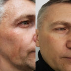 HIFU, EMS and Microcurrent Facial Massager